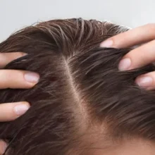 محلول درمانی احیا کف سر اوسرین ضد ریزش و تقویت موهای نازک 100میل