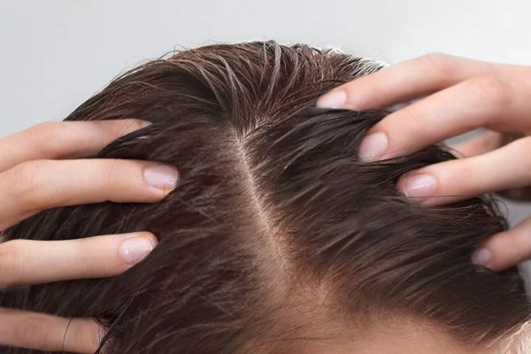 محلول درمانی احیا کف سر اوسرین ضد ریزش و تقویت موهای نازک 100میل
