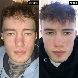 شوینده سالسیلیک اسید اینکی لیست مناسب پوست مختلط چرب و جوش دار