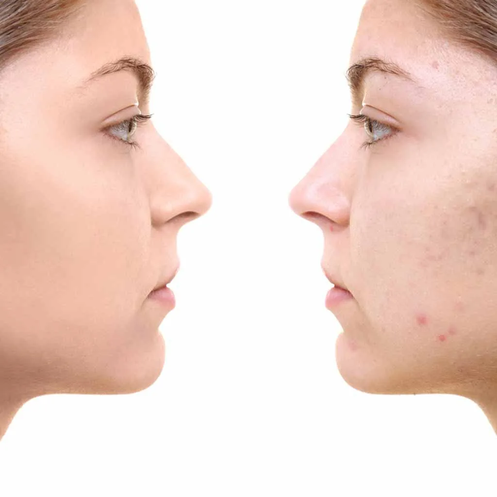 ژل لایه بردار استادرم مناسب پوست لک دار