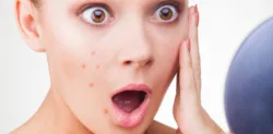جوش و آکنه صورت چیست و چگونه رفع می‌گردد؟