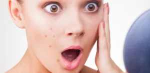 جوش و آکنه صورت چیست و چگونه رفع می‌گردد؟