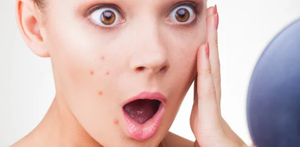 جوش و آکنه صورت چیست و چگونه رفع میگردد؟